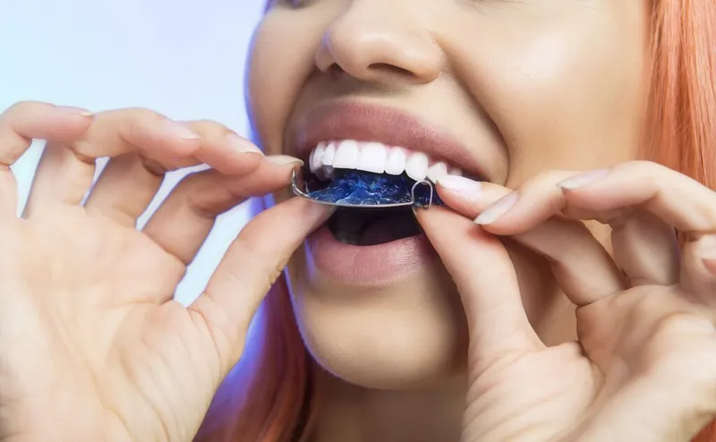 A woman placing a blue removable retainer onto her upper teeth