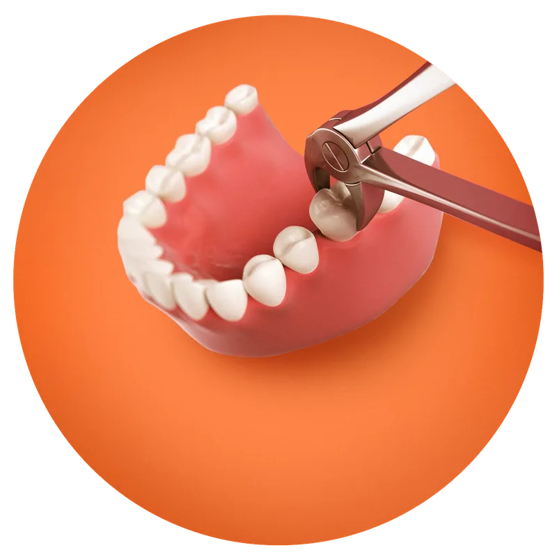 Illustration of forceps gripping a back tooth on a lower jaw model