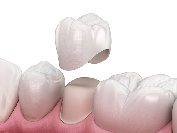 Illustration of a crown being lowered onto a prepared tooth between two natural teeth