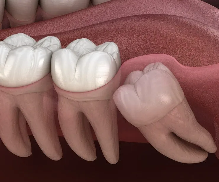 Illustration of a wisdom tooth growing at an angle against the molar in front of it