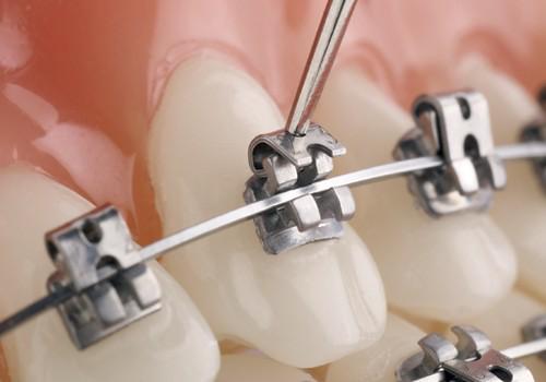 Close-up of a brace bracket and archwire on a dental model