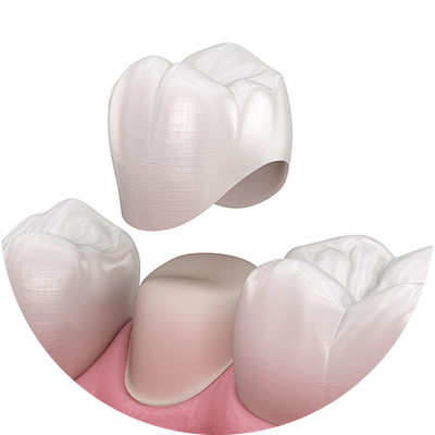 Zirconium dental crown being fitted on a tooth