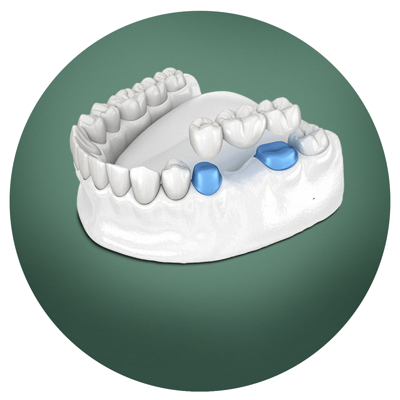 Illustration of a three-tooth bridge being placed over two prepared teeth on a lower jaw model