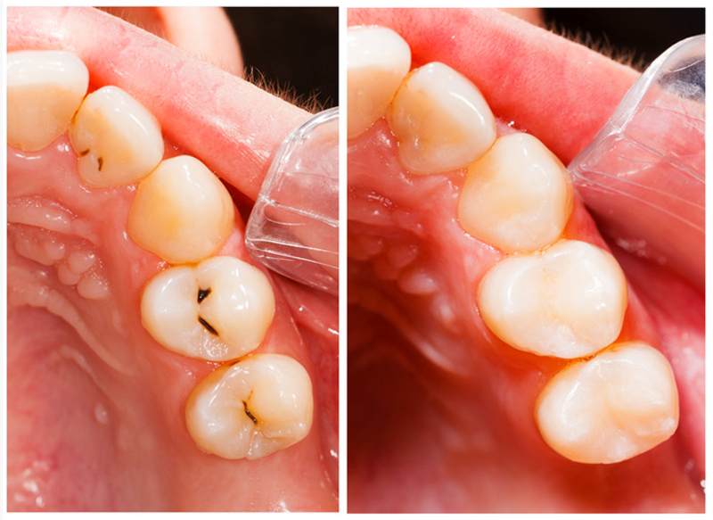 Close-up of two teeth with cavities before treatment and after white fillings